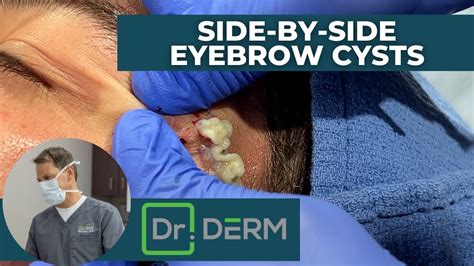 <strong>Derm</strong> removing a lodged earring backing. . Dr derm youtube 2022